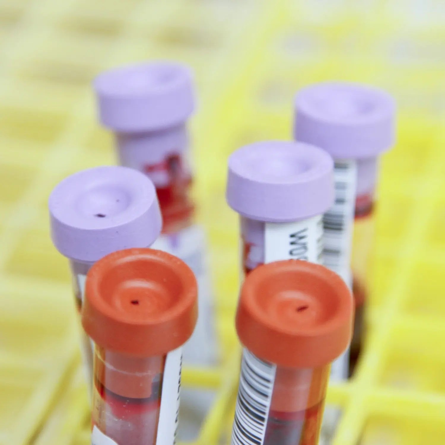 Understanding Low Iron Levels in Athletes: Blood Test Insights and Solutions